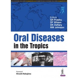 Oral Diseases in the Tropics