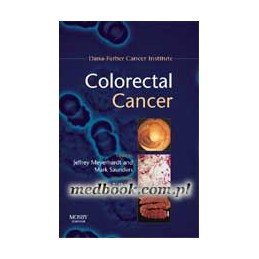 Colorectal Cancer