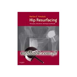 Hip Resurfacing