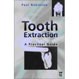 Tooth Extraction