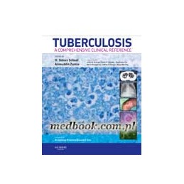 Tuberculosis