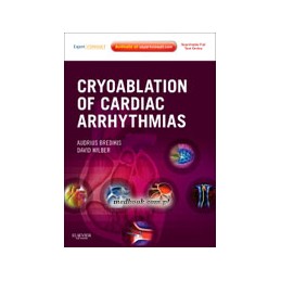 Cryoablation of Cardiac...