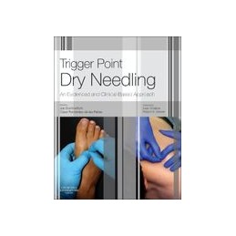 Trigger Point Dry Needling