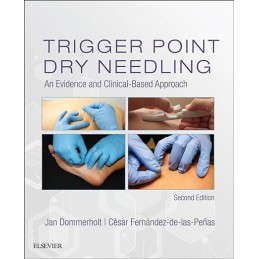 Trigger Point Dry Needling