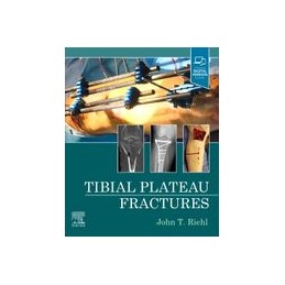 Tibial Plateau Fractures