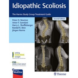 Idiopathic Scoliosis: The...