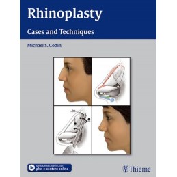 Rhinoplasty: Cases and Techniques