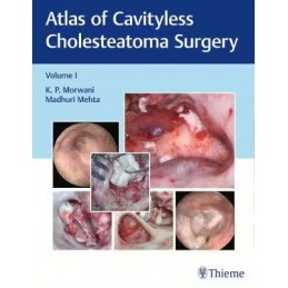 Atlas of Cavityless Cholesteatoma Surgery, Vol 1