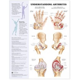 Understanding Arthritis Anatomical Chart