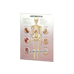 Arthritis: 3D Lenticular Chart