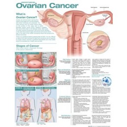 Understanding Ovarian...