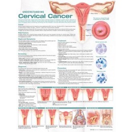 Understanding Cervical Cancer Anatomical Chart