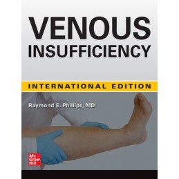 Venous Insufficiency (IE)