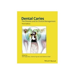 Dental Caries: The Disease and its Clinical Management