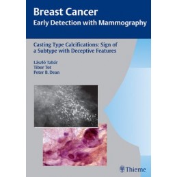 Casting-Type Calcifications: Sign of a Subtype with Deceptive Features