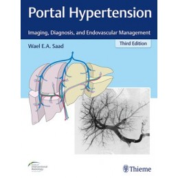 Portal Hypertension: Imaging, Diagnosis, and Endovascular Management