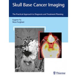 Skull Base Cancer Imaging:...