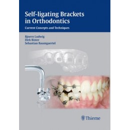 Self-ligating Brackets in...