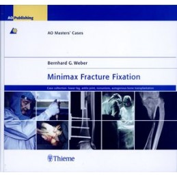 Minimax Fracture Fixation:...