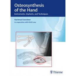 Osteosynthesis of the Hand:...