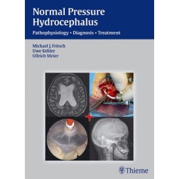 NPH - Normal Pressure...