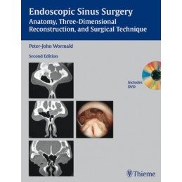 Endoscopic Sinus Surgery:...