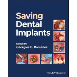 Saving Dental Implants