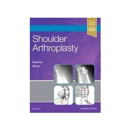 Shoulder Arthroplasty