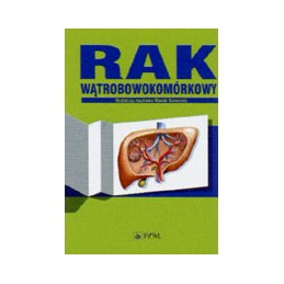 Rak wątrobowokomórkowy