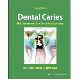 Dental Caries: The Disease...