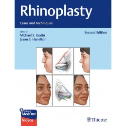 Rhinoplasty: Cases and Techniques