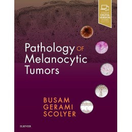 Pathology of Melanocytic...