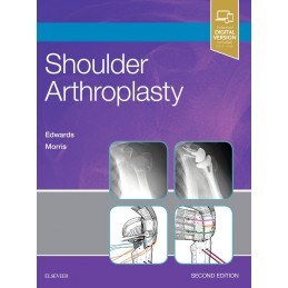 Shoulder Arthroplasty Shoulder Arthroplasty