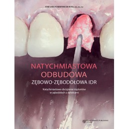 Natychmiastowa odbudowa zębowo-zębodołowa IDR