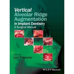 Vertical Alveolar Ridge...