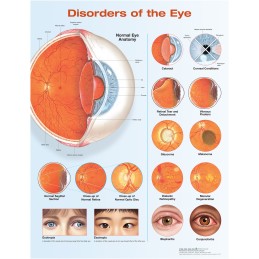 Disorders of the Eye...