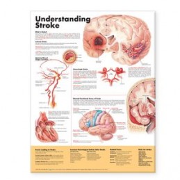 Understanding Stroke...