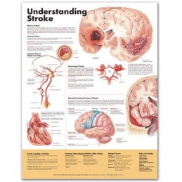 Understanding Stroke Anatomical Chart