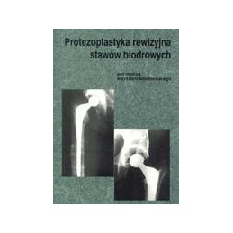 Protezoplastyka rewizyjna...