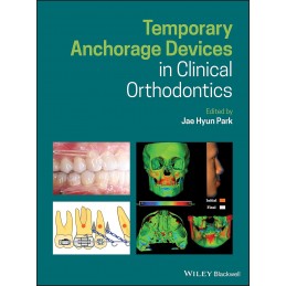 Temporary Anchorage Devices...