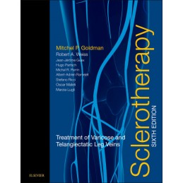 Sclerotherapy