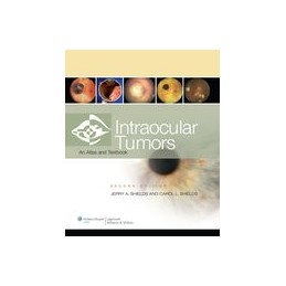 Intraocular Tumors