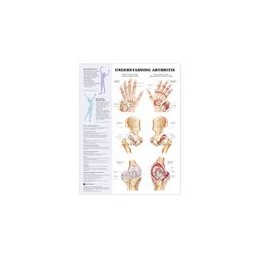 Arthritis - Joint Inflammation Anatomical Chart