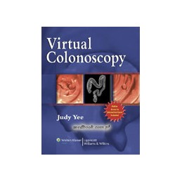 Virtual Colonoscopy