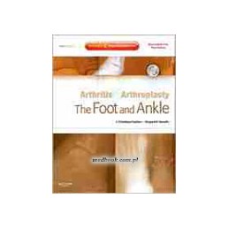 Arthritis and Arthroplasty: The Foot and Ankle