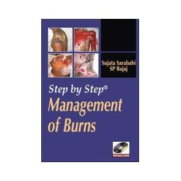 Step by Step Management of Burns