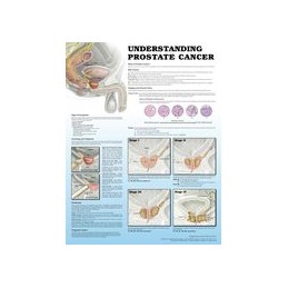 Understanding Prostate Cancer 2e Laminated