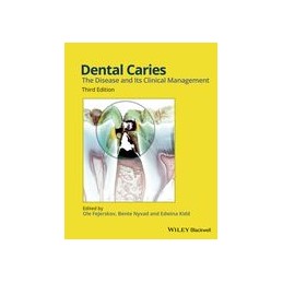Dental Caries: The Disease...