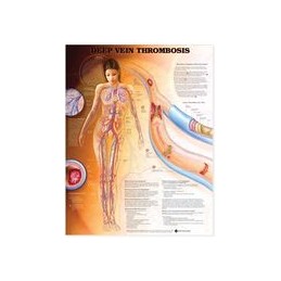 Deep Vein Thrombosis...