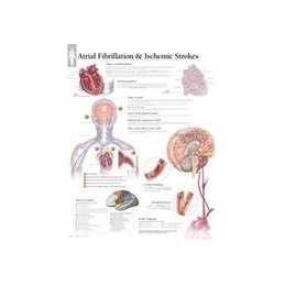 Atrial Fib & Ischemic Strokes Laminated Poster